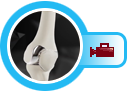 Jiffy Knee Joint Replacement