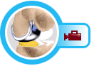Unicondylar Knee Replacement